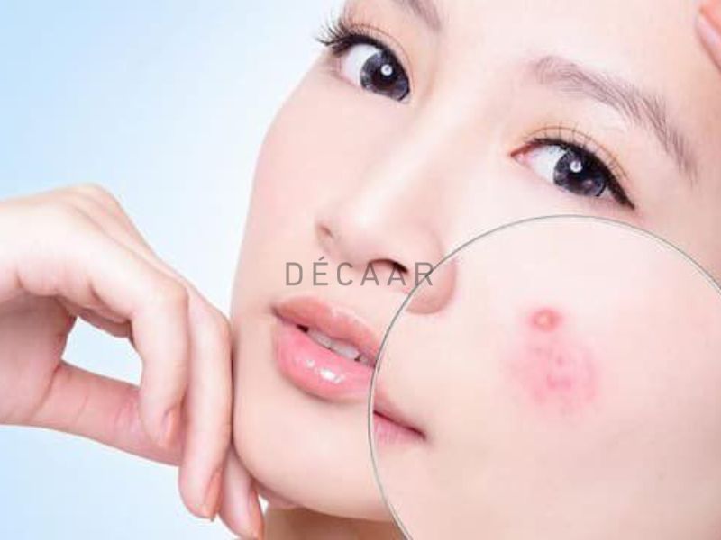 nguyên nhân mụn trứng cá bọc